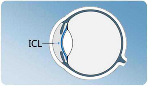 ICL晶体植入术能否治疗超高度近视？